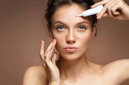 L'acné : comment la traiter ?